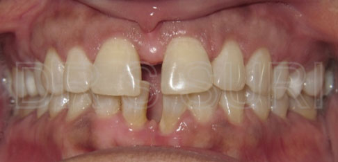 Dr. Suri Orthodontics Case 2 Before