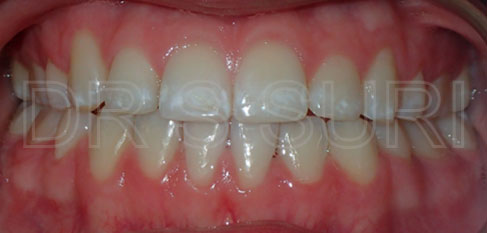 Dr. Suri Orthodontics Case 7 After