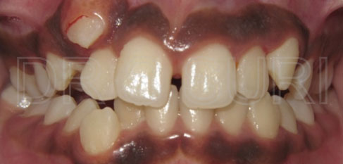 Dr. Suri Orthodontics Case 8 Before