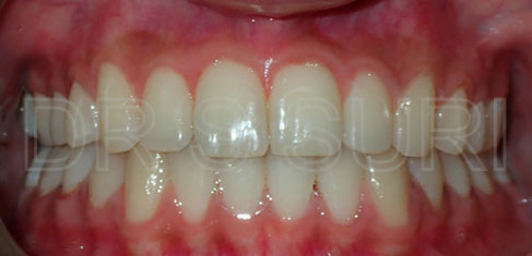 Dr. Suri Orthodontics Case 1 After