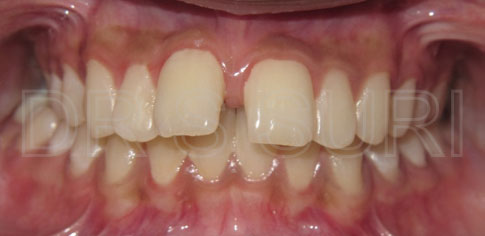 Dr. Suri Orthodontics Case 1 Before