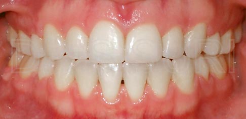 Dr. Suri Orthodontics Case 10 After