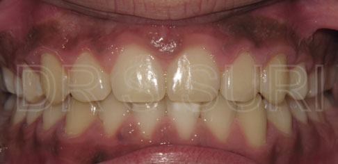 Dr. Suri Orthodontics Case 11 After