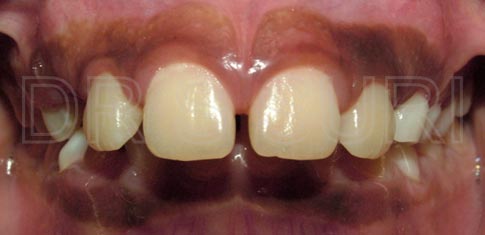 Dr. Suri Orthodontics Case 11 Before