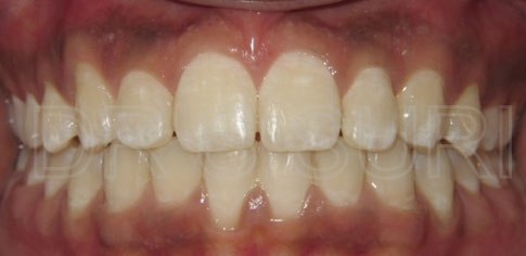 Dr. Suri Orthodontics Case 12 After