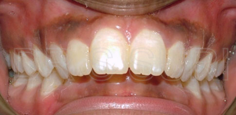 Dr. Suri Orthodontics Case 12 Before