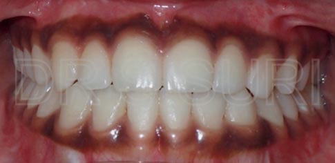 Dr. Suri Orthodontics Case 13 After