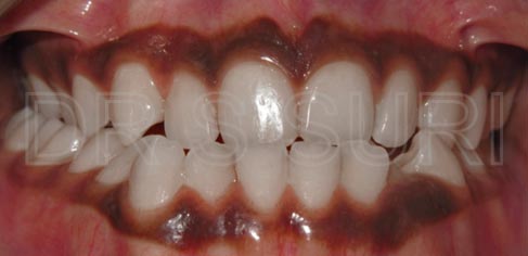 Dr. Suri Orthodontics Case 13 Before