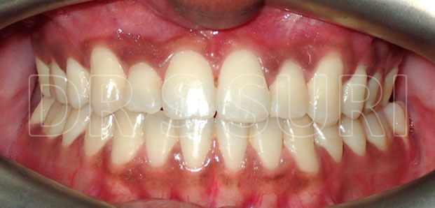 Dr. Suri Orthodontics Case 14a After