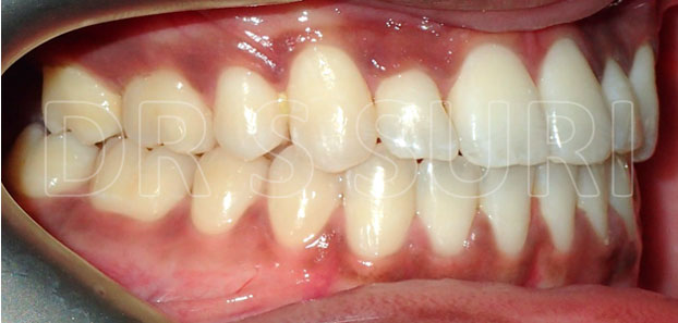 Dr. Suri Orthodontics Case 14b After