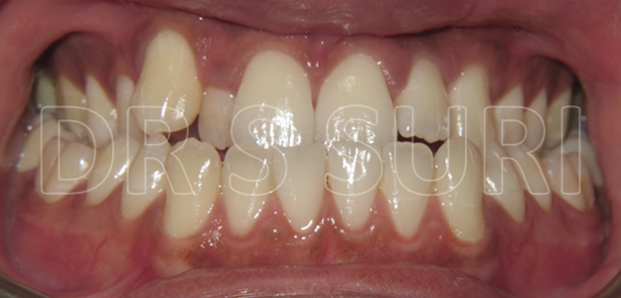 Dr. Suri Orthodontics Case 14a Before
