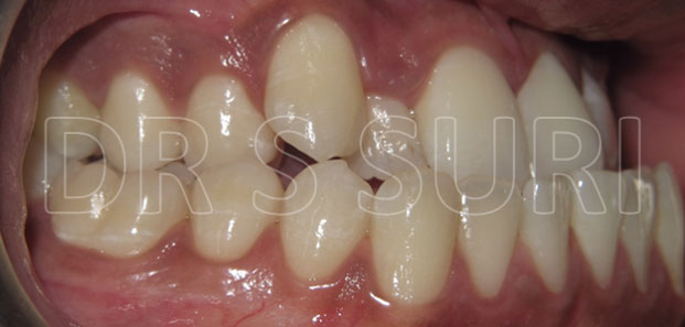 Dr. Suri Orthodontics Case 14b Before