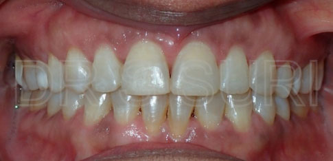 Dr. Suri Orthodontics Case 2 After