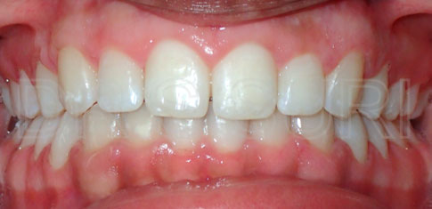 Dr. Suri Orthodontics Case 3 After