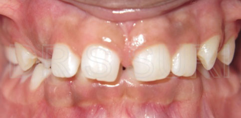 Dr. Suri Orthodontics Case 3 Before