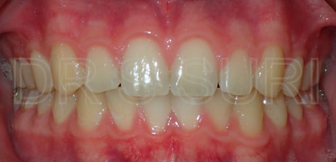 Dr. Suri Orthodontics Case 4 After