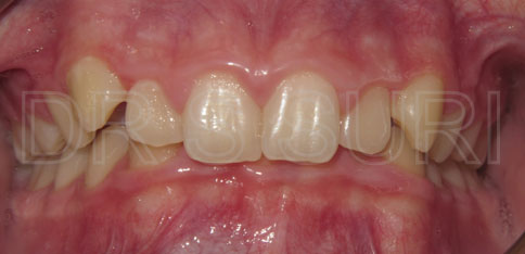 Dr. Suri Orthodontics Case 4 Before