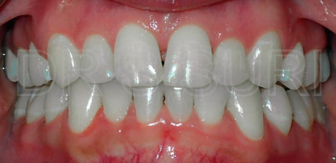 Dr. Suri Orthodontics Case 5 After