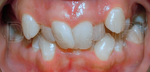 Dr. Suri Orthodontics Case 5 Before
