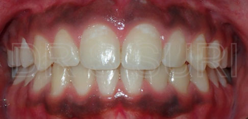 Dr. Suri Orthodontics Case 6 After