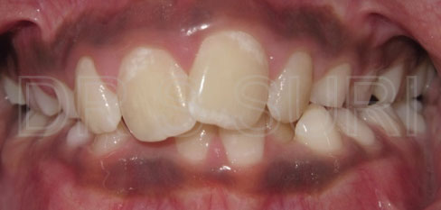 Dr. Suri Orthodontics Case 6 Before
