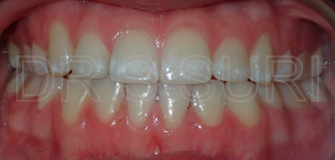 Dr. Suri Orthodontics Case 7 After