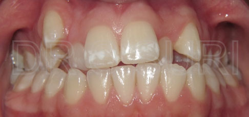 Dr. Suri Orthodontics Case 7 Before