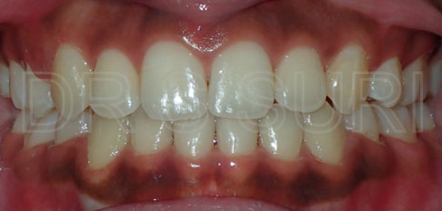 Dr. Suri Orthodontics Case 8 After
