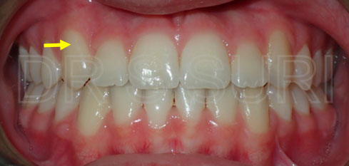 Dr. Suri Orthodontics Case 9 After