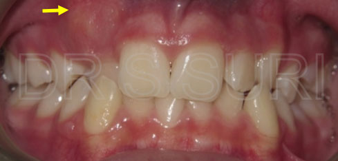 Dr. Suri Orthodontics Case 9 Before