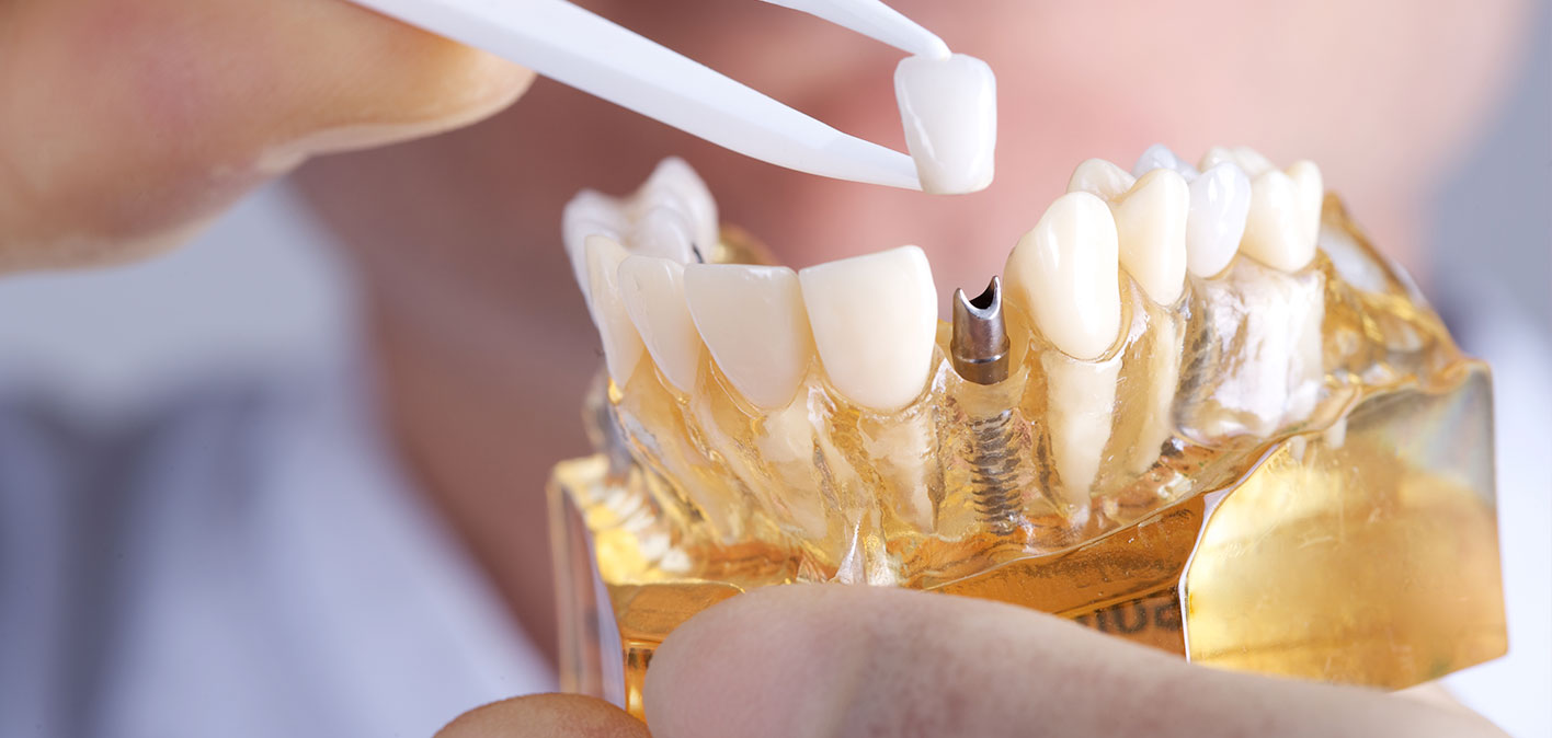 Dental Implants