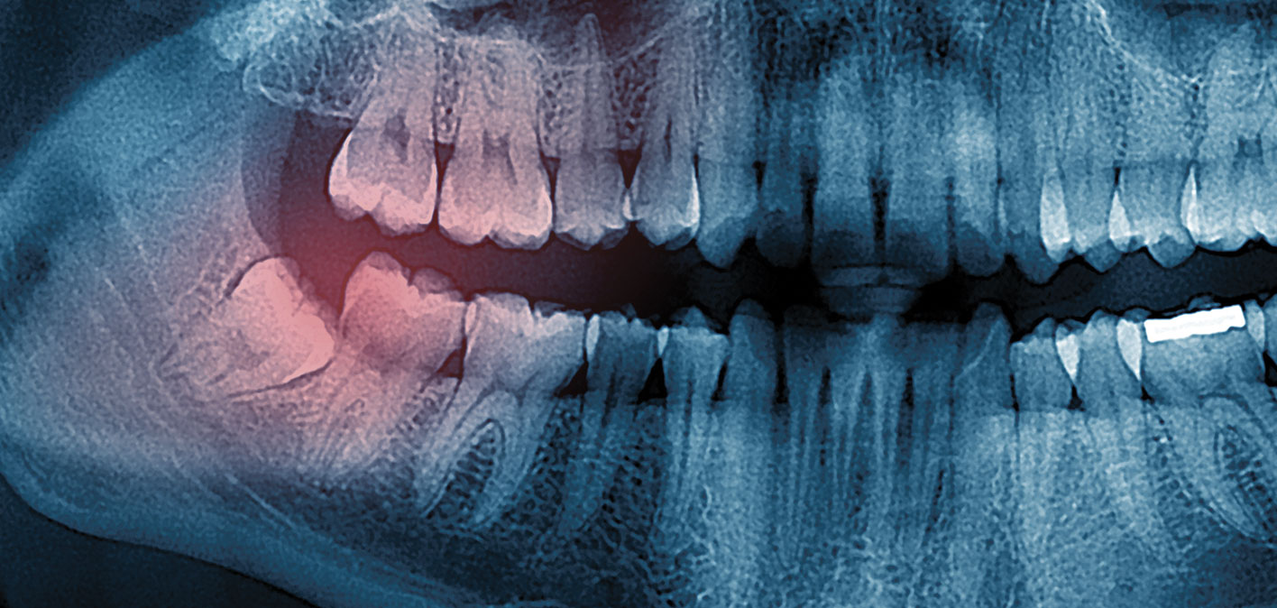 Xray Wisdom Teeth