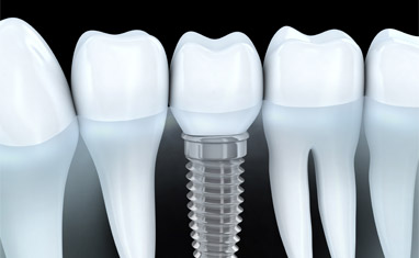 Dental Implants